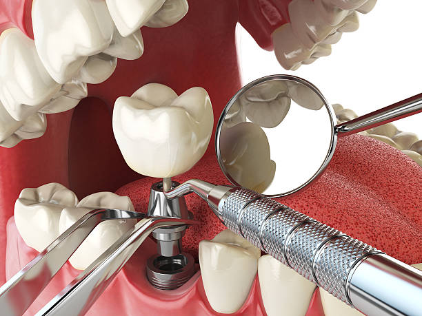 Best Emergency Wisdom Tooth Extraction in Fanwood, NJ